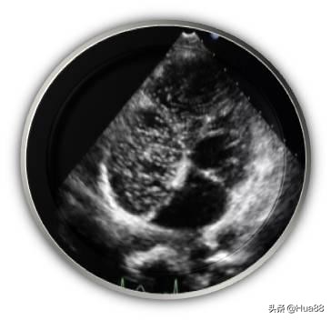 早产儿心脏卵圆孔未闭,卵圆孔未闭的原因