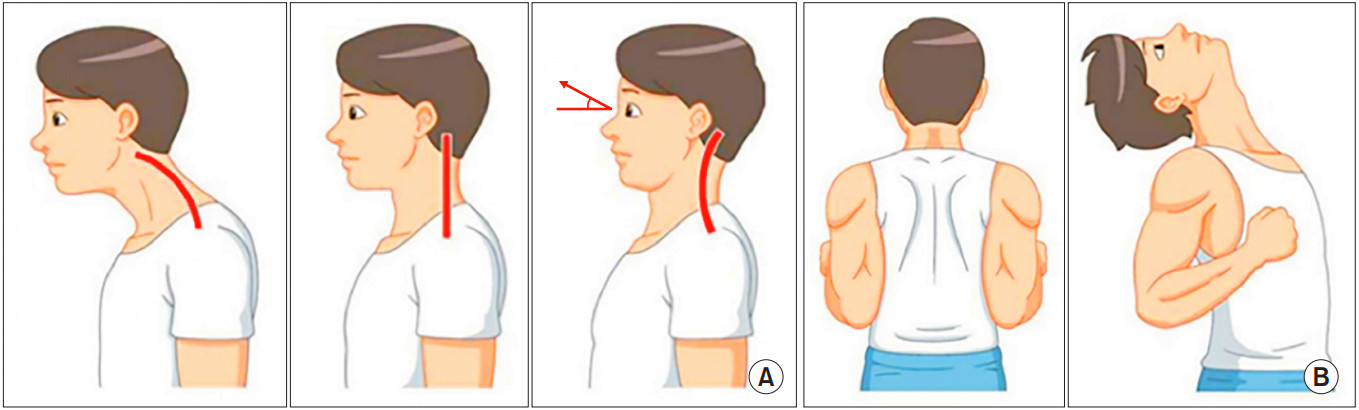 颈椎生理曲度过曲是啥意思,颈椎生理弯曲变直反弓怎么治疗