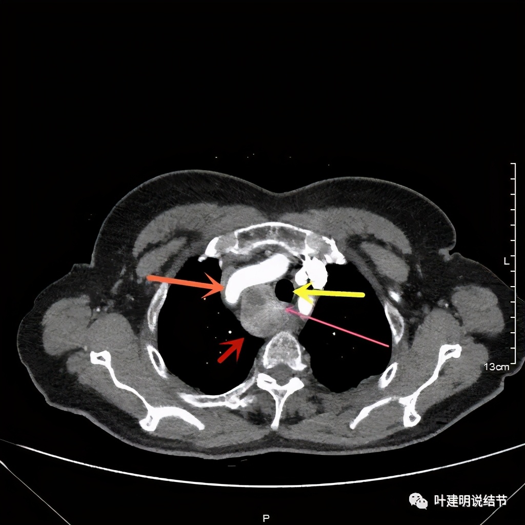胸部高分辨ct检查注意事项,胸部ct扫描有没有危害