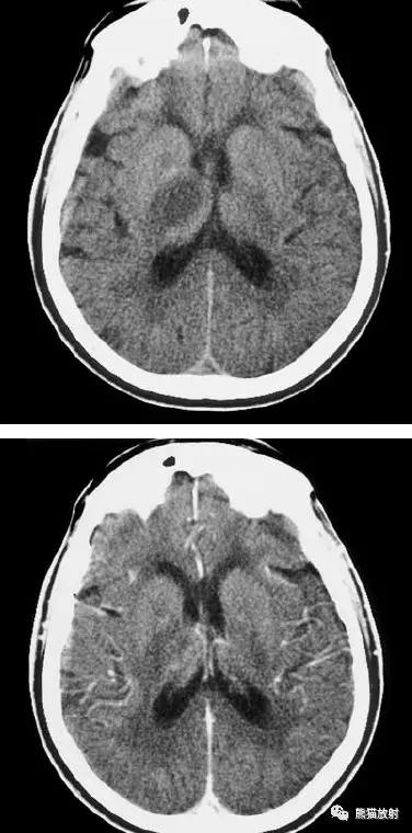 脑梗死丨演变、血供区域分布、CT表现