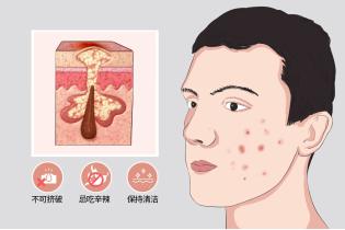 长青春痘怎么办,长青春痘的征兆是什么
