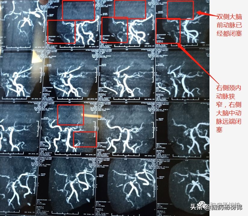 脑梗塞病人拉肚子怎么办,感冒会引起脑梗头晕的加重吗