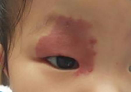 婴儿胎记激光治疗,新生儿胎记最佳治疗