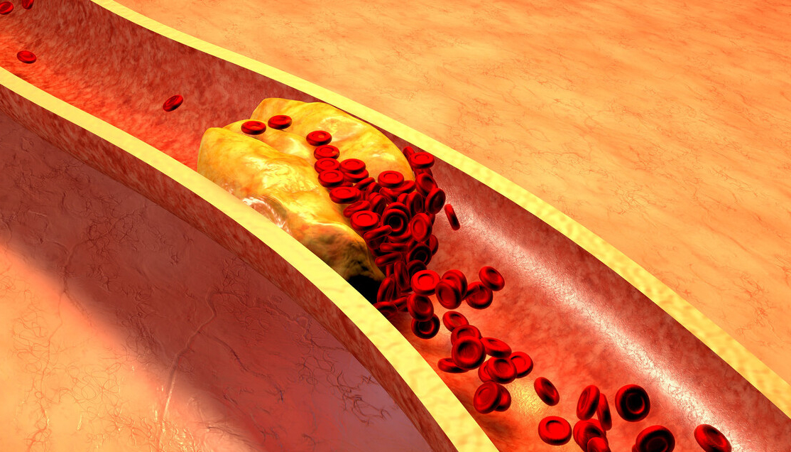 引起血液浓稠的原因有哪些,导致血液粘稠的食物