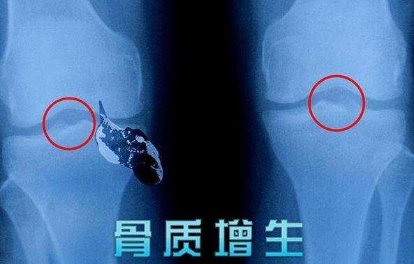 长骨刺说明你身体开始变老了,长骨刺的原因和治疗方法