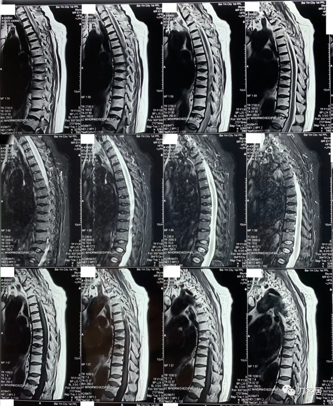 胸椎压缩性骨折病历,脊柱骨质疏松性压缩性骨折