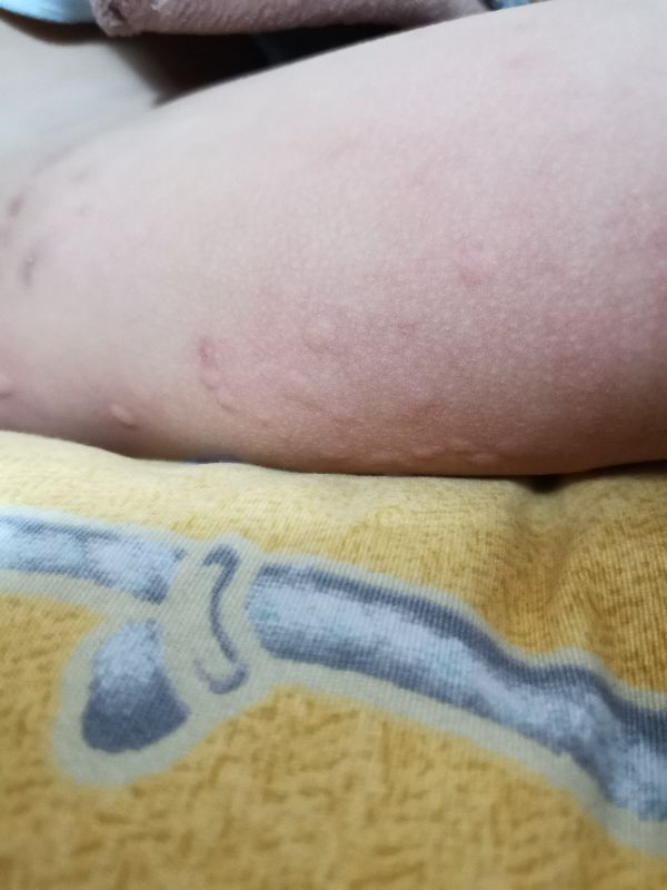 宝宝身上起疙瘩像蚊子咬一样还痒,宝宝身上长疙瘩像蚊虫叮咬怎么办
