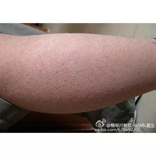 鸡皮肤夏天会好一些吗,夏天鸡皮肤解决方法