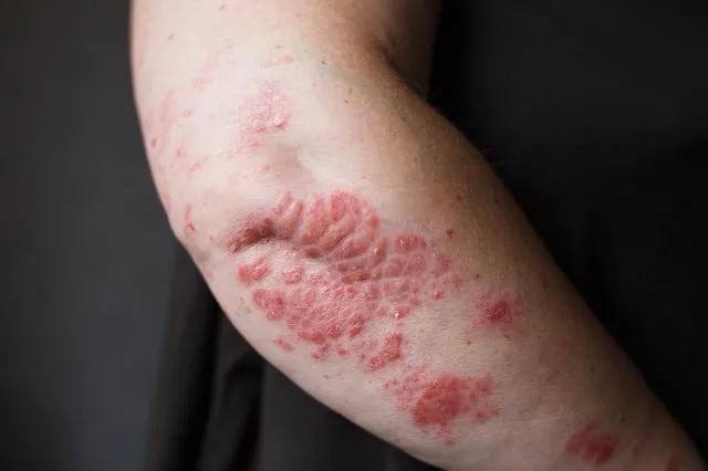 一针 6600 元，一年 12 万，650 万患者不能承受之重