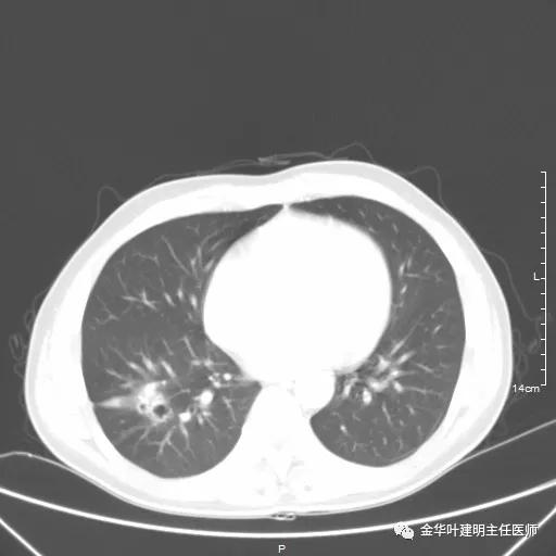 伴有脑转移了的肺癌能手术吗？