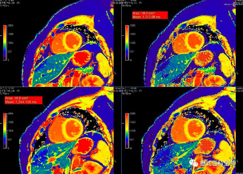 心脏磁共振定位方法,心脏磁共振各参数分析