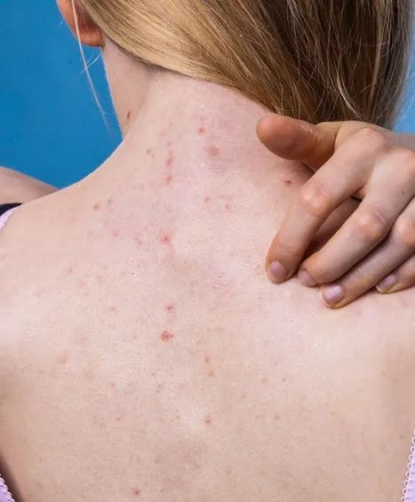 女孩脚气溃烂怎么治,梅毒脚气一直不好