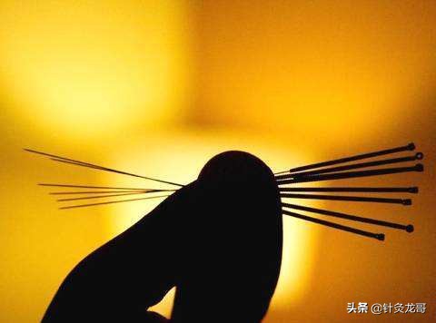 糖尿病的针灸最佳穴位,针灸治疗糖尿病靠谱吗