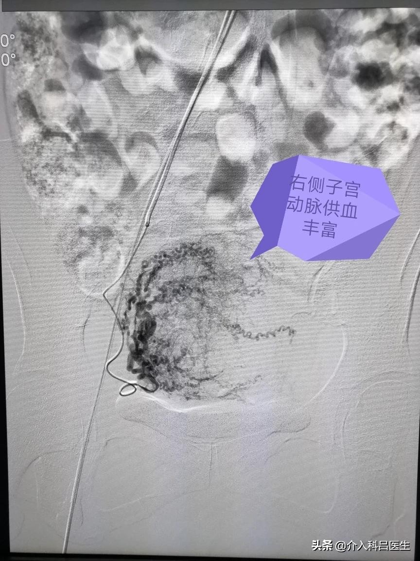 子宫腺肌症中度贫血,女性腺肌症贫血怎么调理