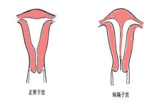 子宫的故事绘本,子宫畸形患者故事
