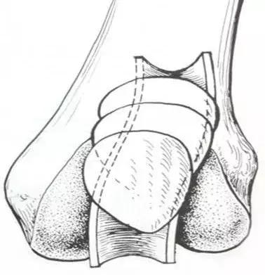 运动损伤膝盖一般用什么药,运动损伤膝盖疼怎么办