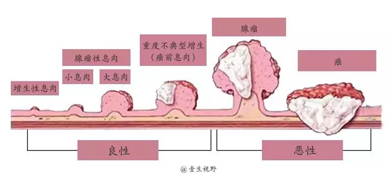 什么是癌前病变干预,什么是癌前病变
