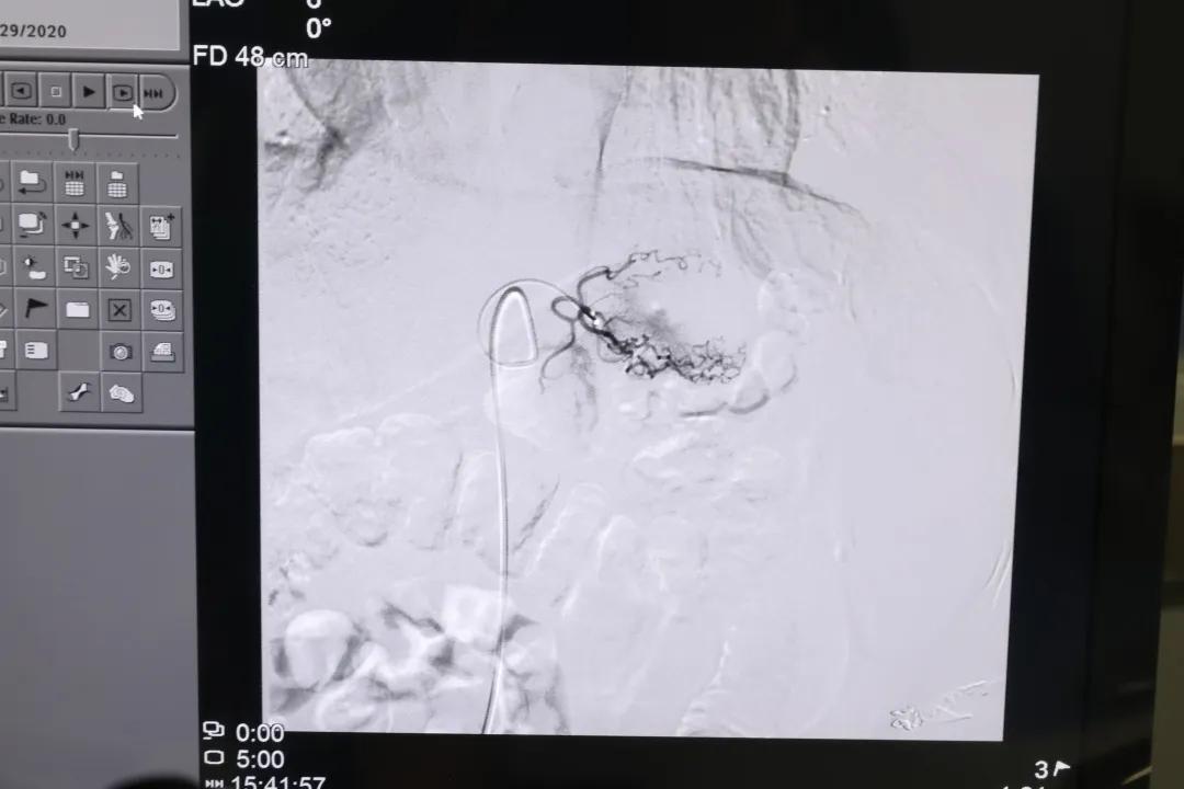 dsa动脉血管灌注栓塞术可靠吗,介入栓塞和灌注化疗