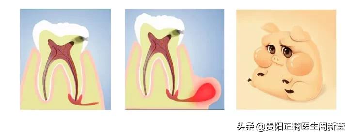 牙疼淋巴肿大是什么原因引起的,牙疼白天不疼晚上疼是什么原因