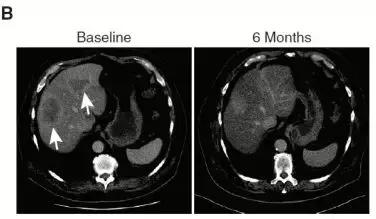 胃癌切除后基因检测与靶向治疗,基因测序治疗胃癌