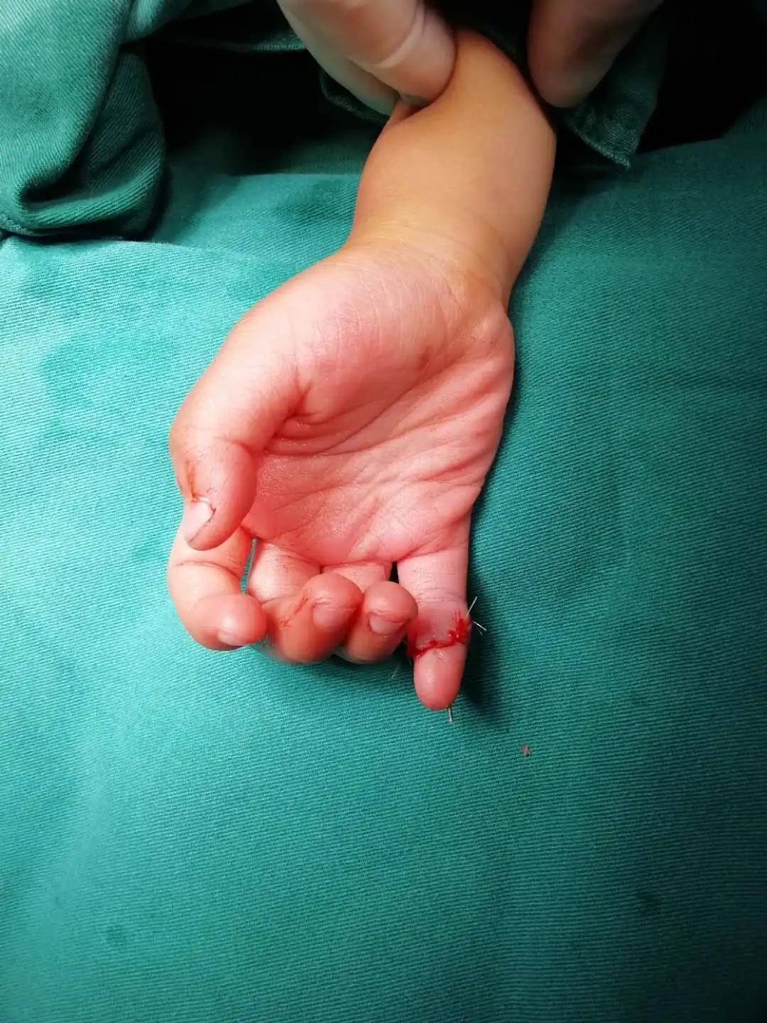 断指再植接动脉显微镜视频,穿针引线手术