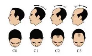 脱发的原因有哪些快点进来看看吧,出现这两种脱发别慌一招帮您搞定