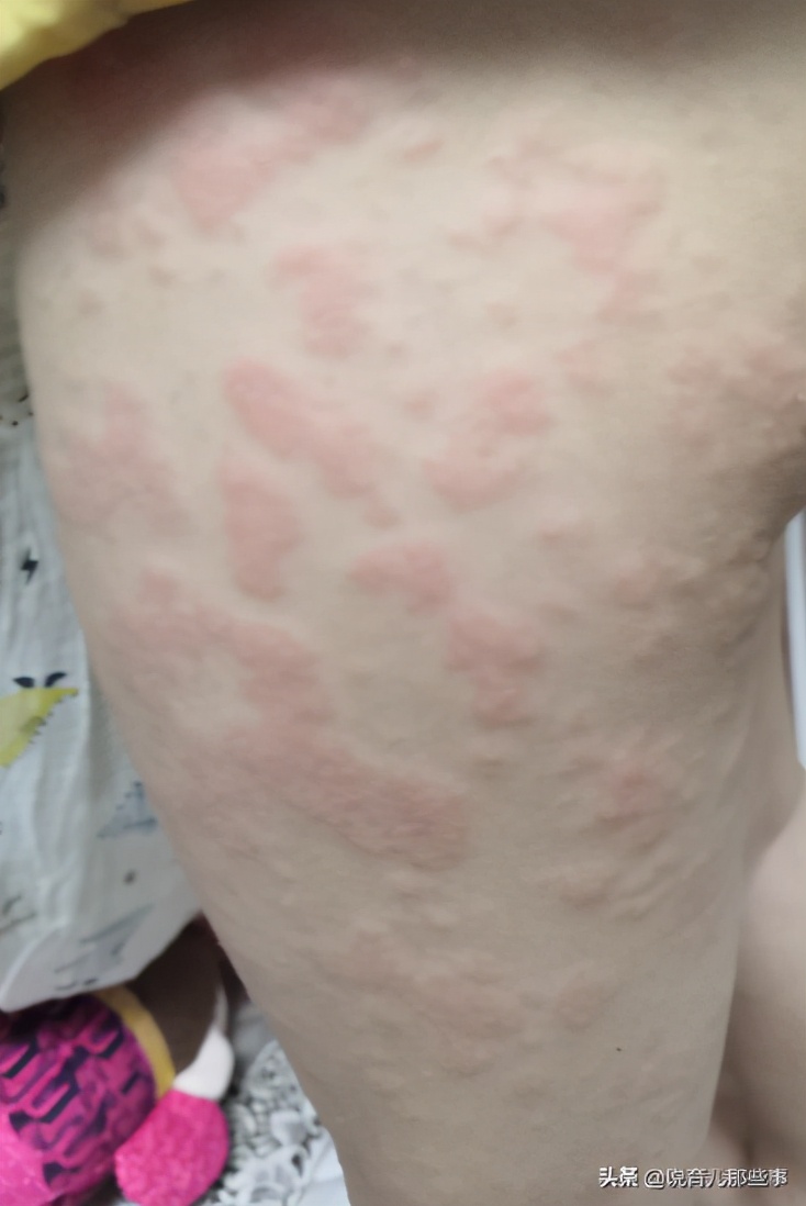 很恐怖的过敏图片,过敏发朋友圈的真实图片