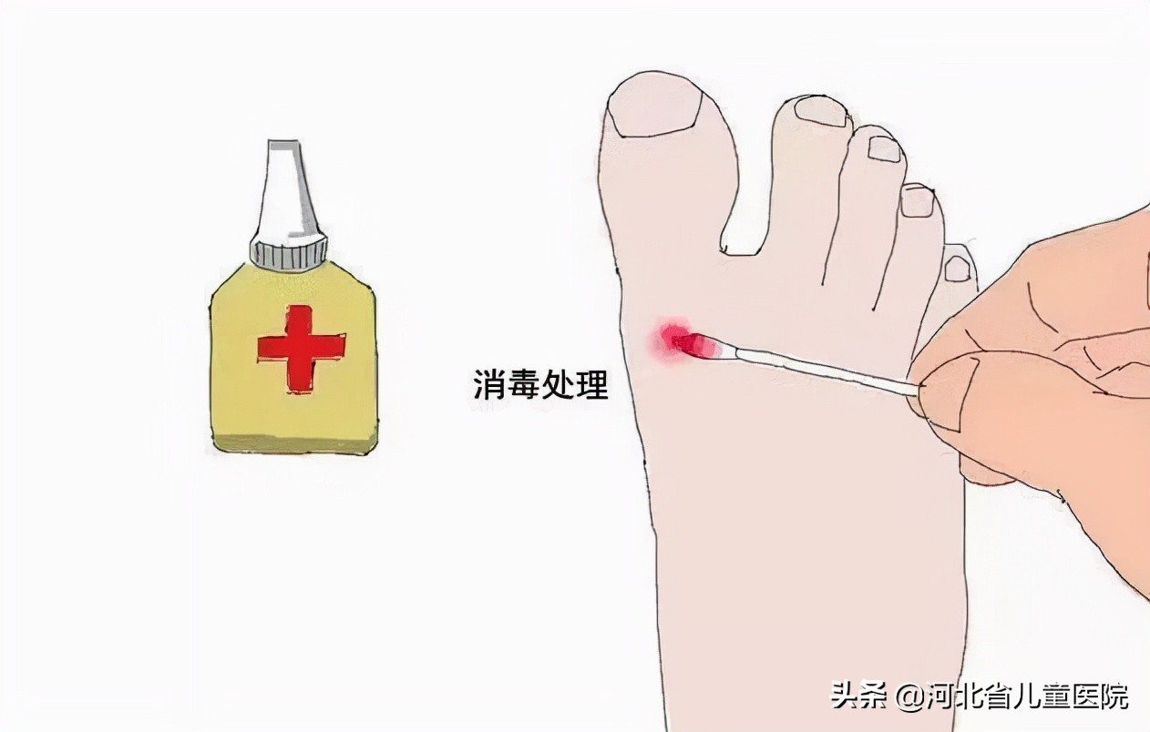 孩子的脚被孩子咬怎么处理,电动车绞住孩子脚怎么办