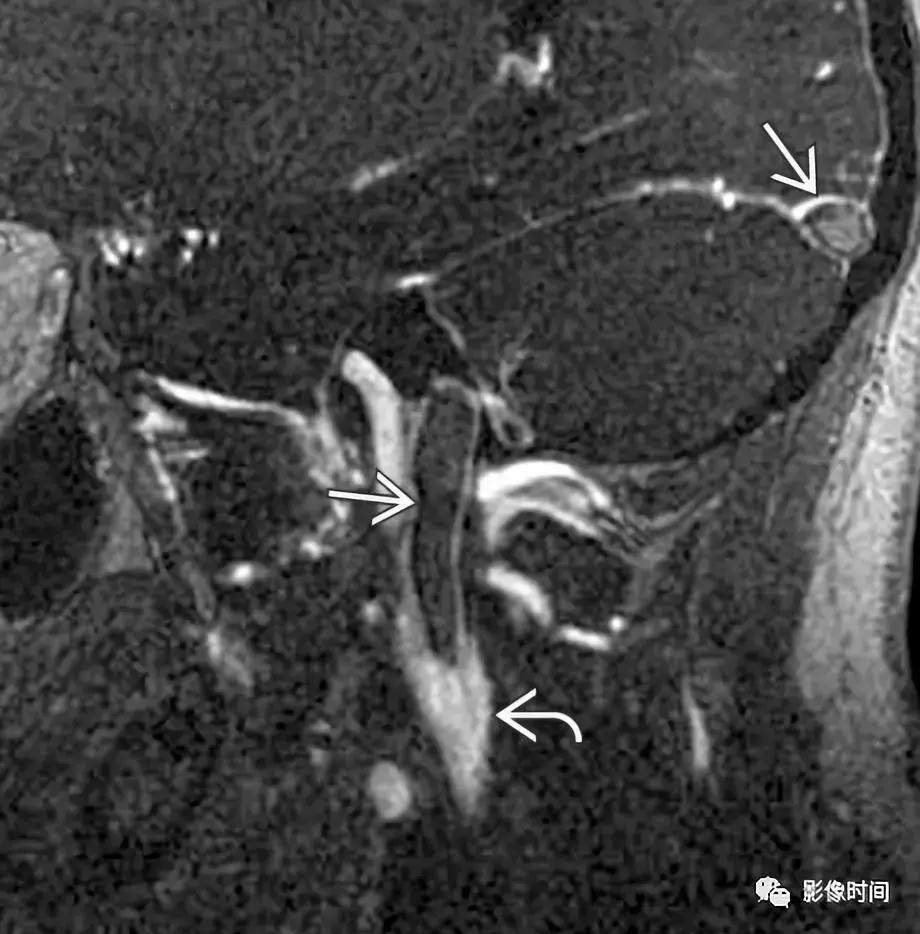 双侧颈动脉鞘间隙多发小淋巴结影,双侧颈动脉间隙多软组织密度结节