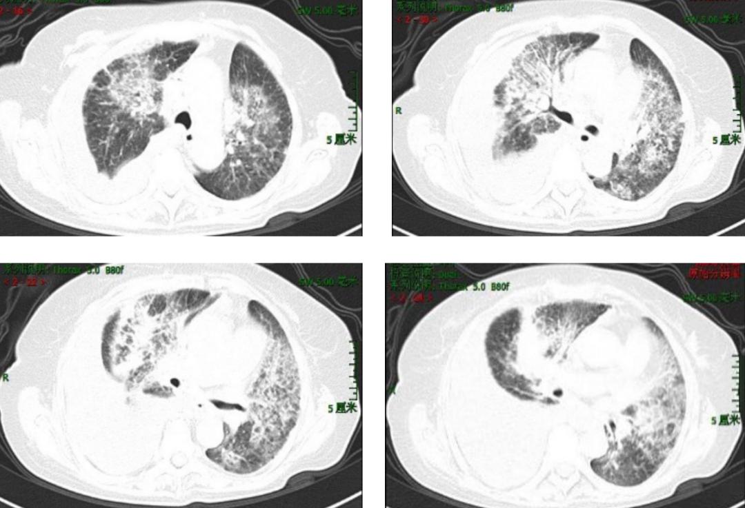 胸腔积液并有顽固性咳嗽,胸腔积液无症状