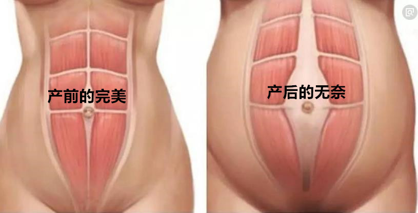 产后妊娠纹肚皮松怎么解决,产后肚子松垮小腹突出