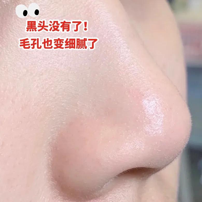 黑头终结者！攒了15年黑头连根拔起，鼻子比钱包还干净