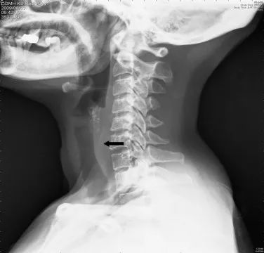 医生们曾在人体内取出过多少神奇的物件?