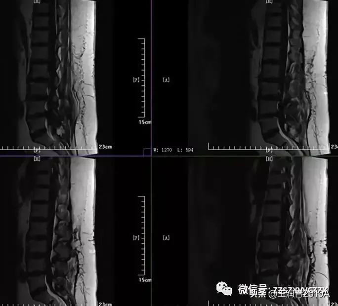 弯腰捡东西,腰痛腿麻大小便*禁失**,竞是腰椎间盘髓核脱出惹的祸