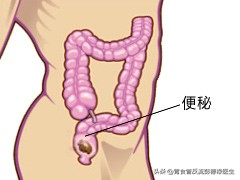 夫妻同时去医院看病,夫妻同时出现便秘