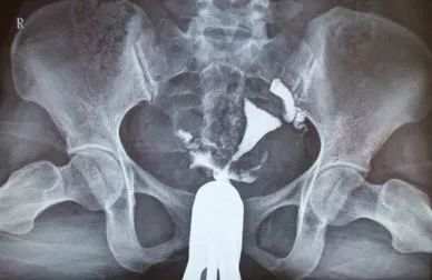 输卵管造影十大忌讳,输卵管造影真实案例感受