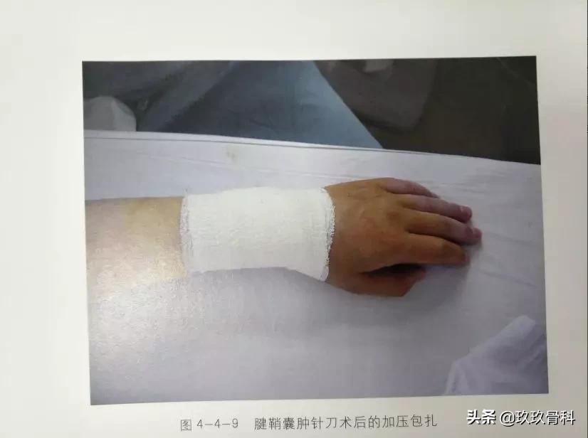 腱鞘囊肿针刺技巧视频,手指腱鞘囊肿正确挤压方法视频