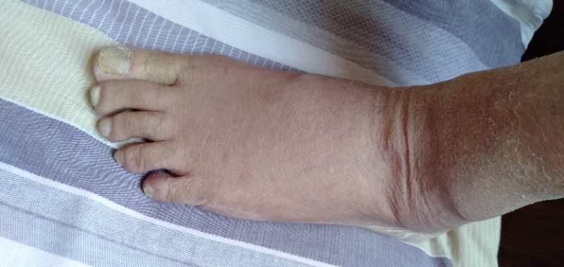 中西医结合治疗原因不明肠梗阻、腹水转氨酶明显升高病案一例！