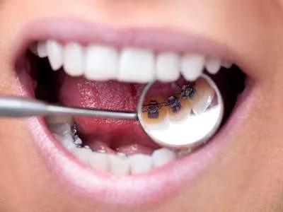 牙套价格表哪种牙套简单又好,最便宜的牙套是哪种牙套