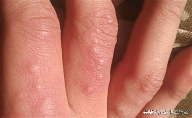 医生治汗疱疹的方法,汗疱疹奇痒无比如何缓解