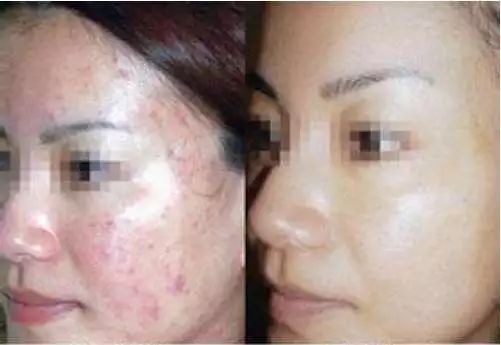 痘印黑色素沉淀怎么遮盖,痘印暗斑怎么快速消除