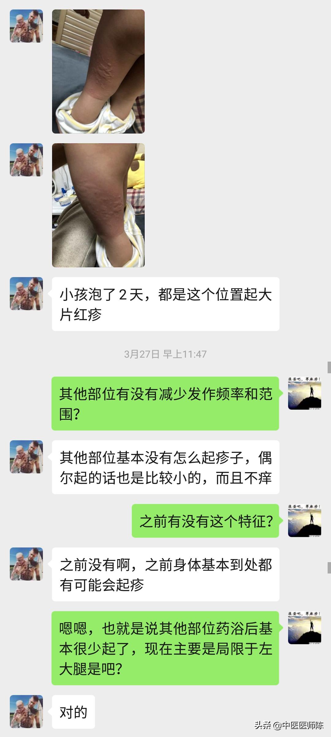 儿童慢性荨麻疹不治疗会自愈吗,儿童慢性荨麻疹治疗不吃药就复发