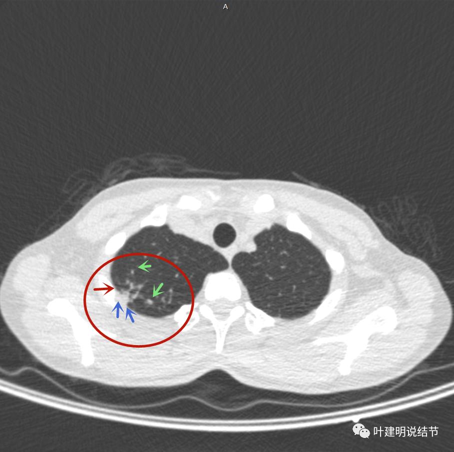 临床诊断孤立性肺结节,空洞型结节一般是什么性质