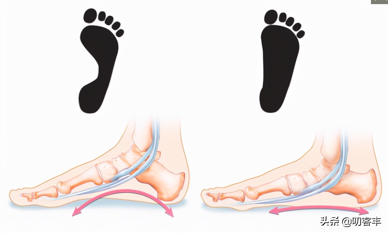 平足如果长期站立会怎样,平足怎么办运动的时候不疼