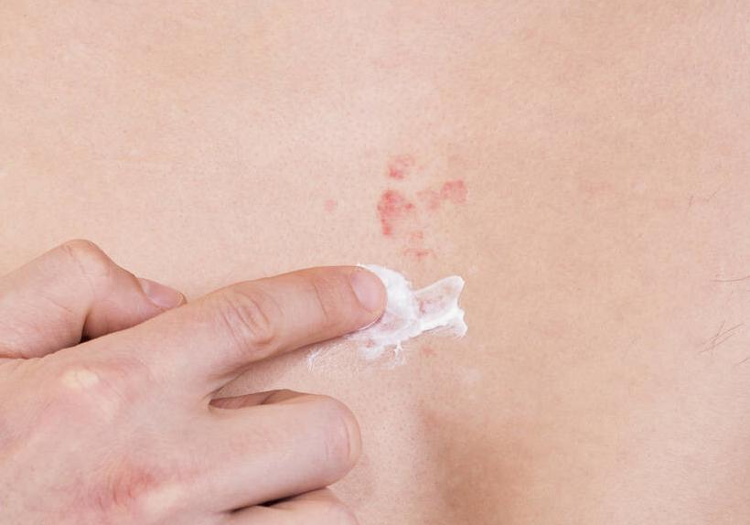 银屑病大量掉屑是脏东西吗,银屑病开始掉屑了吗