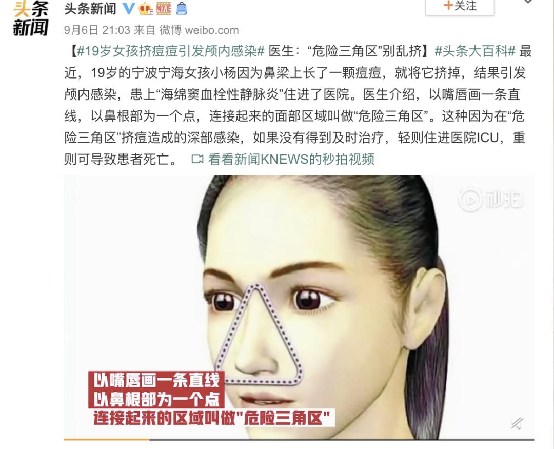 大学生挤痘痘引发的惨剧,女生挤痘痘导致面部感染
