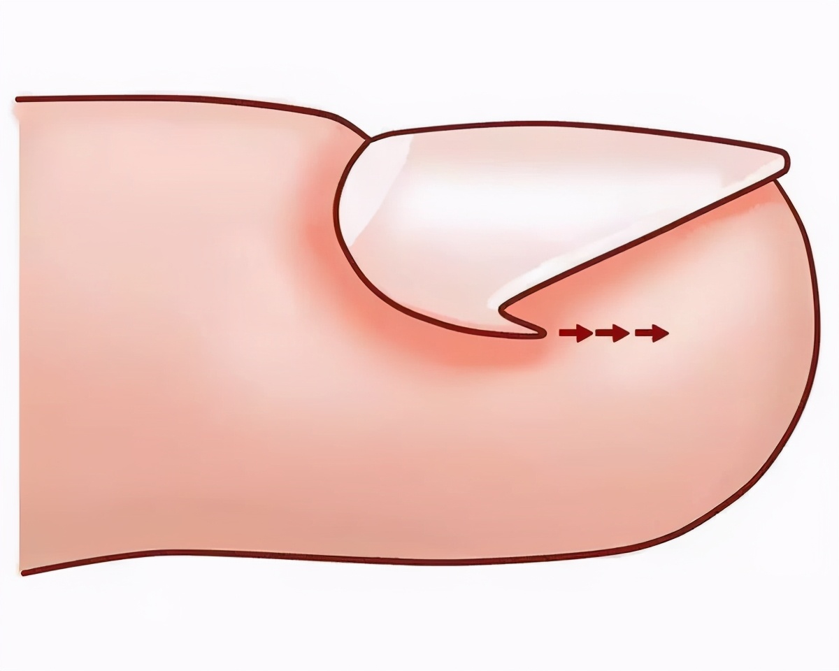 得了甲沟炎有什么注意事项,甲沟炎不是很严重时应该怎么办
