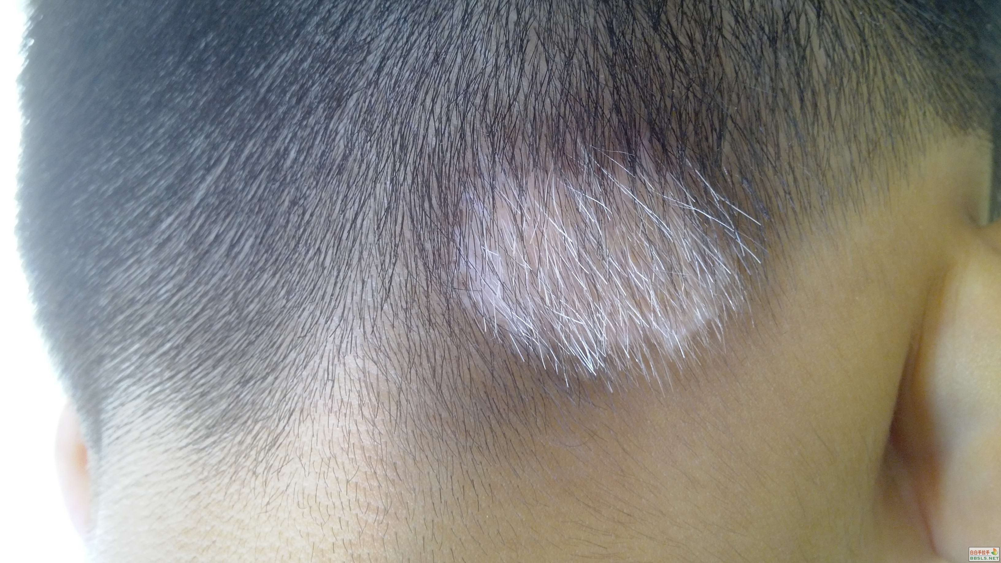 白癜风为什么毛发也会变白,白癜风为什么会导致白头发