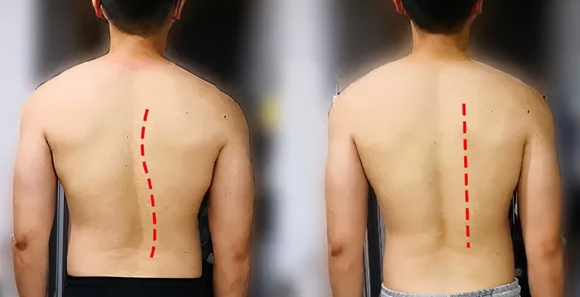 脊柱无侧弯但两侧腰线不对称,两边腰线弧度不一样是脊柱侧弯吗