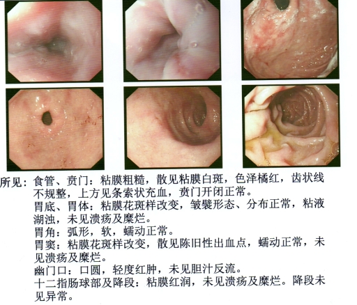 中医治疗萎缩性胃炎伴糜烂的医案,萎缩性胃炎治愈100例